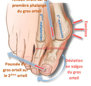 chir_hallux_2.jpg chir_hallux_2.jpg
