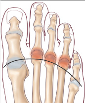 chir_hallux_6.jpg