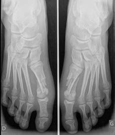 chir_hallux_8.jpg