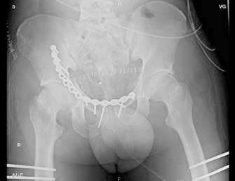 Figure Figure 3-Traitement chirurgical des lésions sacro-iliaques