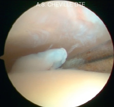Chir_Arthroscopie_4.jpg Chir_Arthroscopie_4.jpg