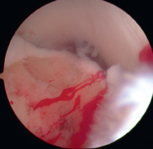 Chir_Arthroscopie_6.jpg Chir_Arthroscopie_6.jpg