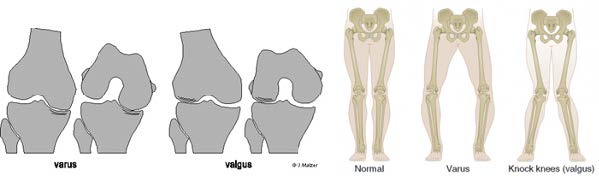 Chir_osteotomie_2.jpg Chir_osteotomie_2.jpg