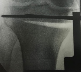 Chir_osteotomie_3.jpg Chir_osteotomie_3.jpg