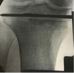 Chir_osteotomie_4.jpg Chir_osteotomie_4.jpg