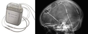 neurostimulation-electrodes-definitives.jpg