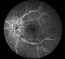 Angiographie-retinienne.png