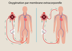 ecmo-(1).png